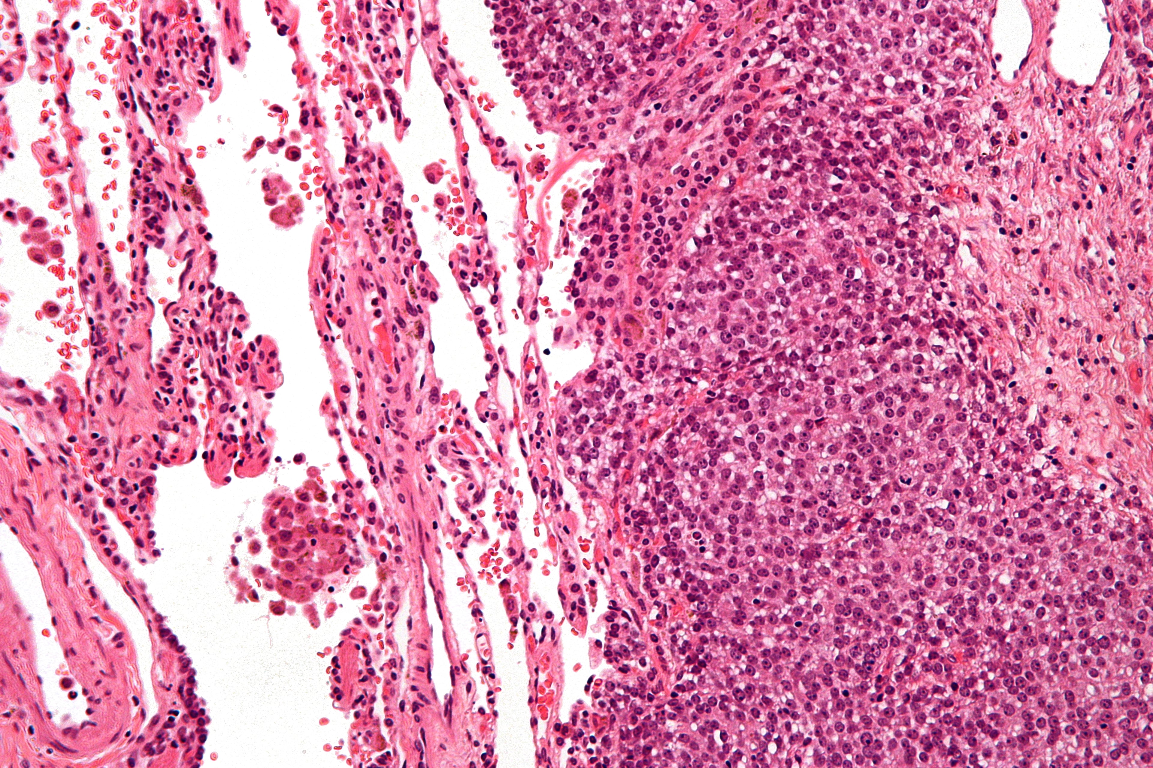High-magnification haematoxylin and eosin photomicrograph of Ewing sarcoma showing sheets of monotonous small round cells with scant cytoplasm.