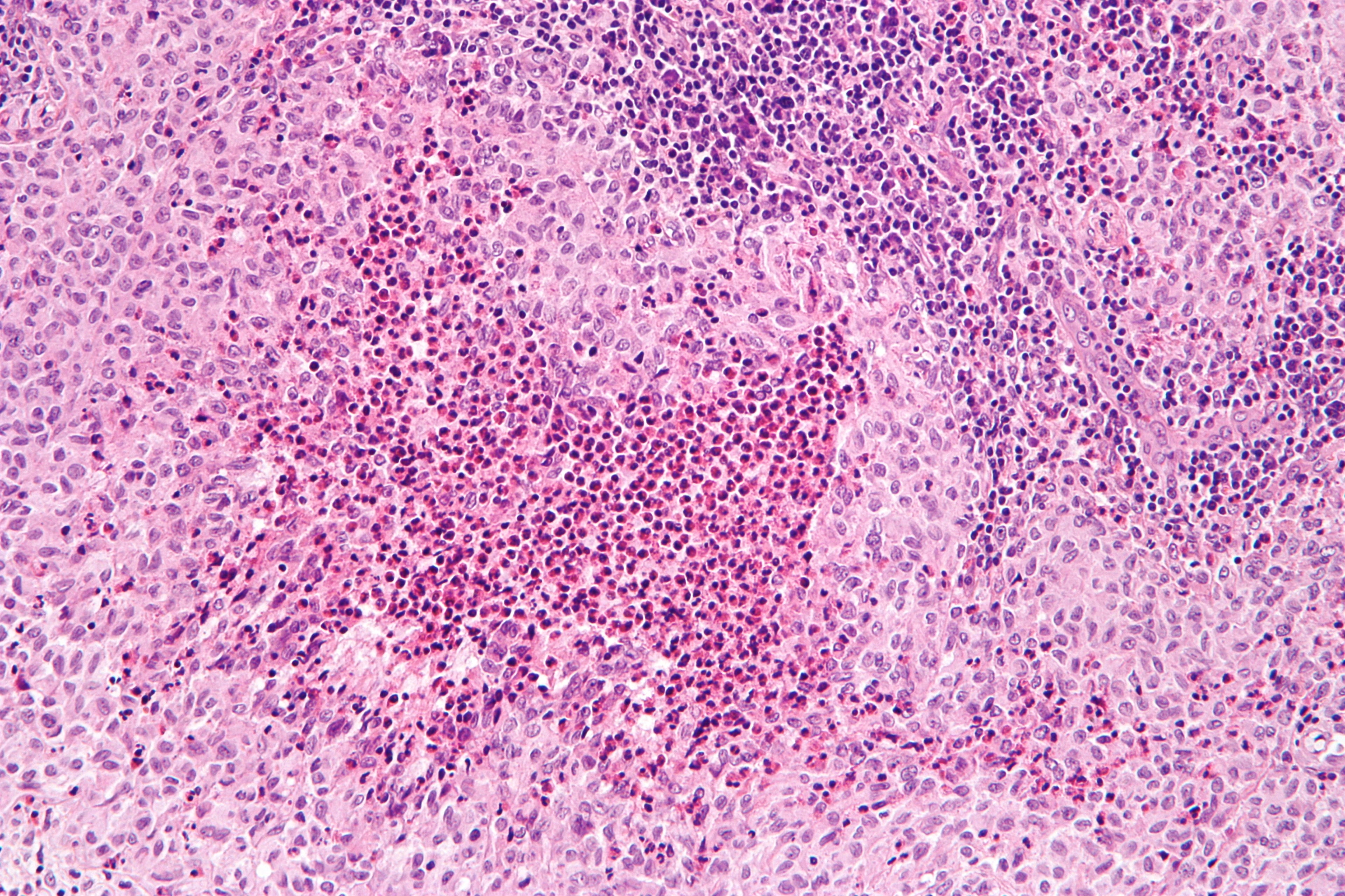 High-magnification haematoxylin and eosin photomicrograph of Langerhans cell histiocytosis showing grooved coffee-bean nuclei in an inflammatory background.