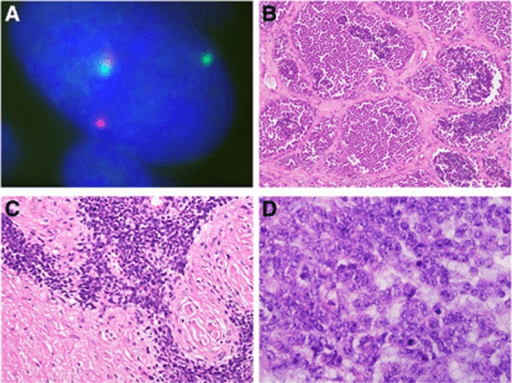 Fluorescence in situ hybridisation images with split red and green signals, paired with histology panels of variant Ewing sarcoma.