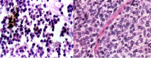 Paired cytology smear and histology section from a case of Ewing's sarcoma.