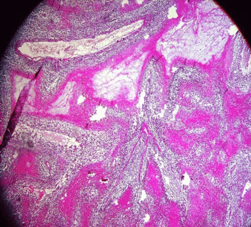 Microscopic view of a small-round-cell tumour showing sheets of small blue cells with large areas of necrosis.