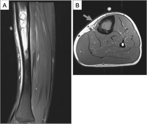 Sagittal and axial MRI of the tibia showing a high-signal medullary diaphyseal lesion with adjacent reactive oedema.