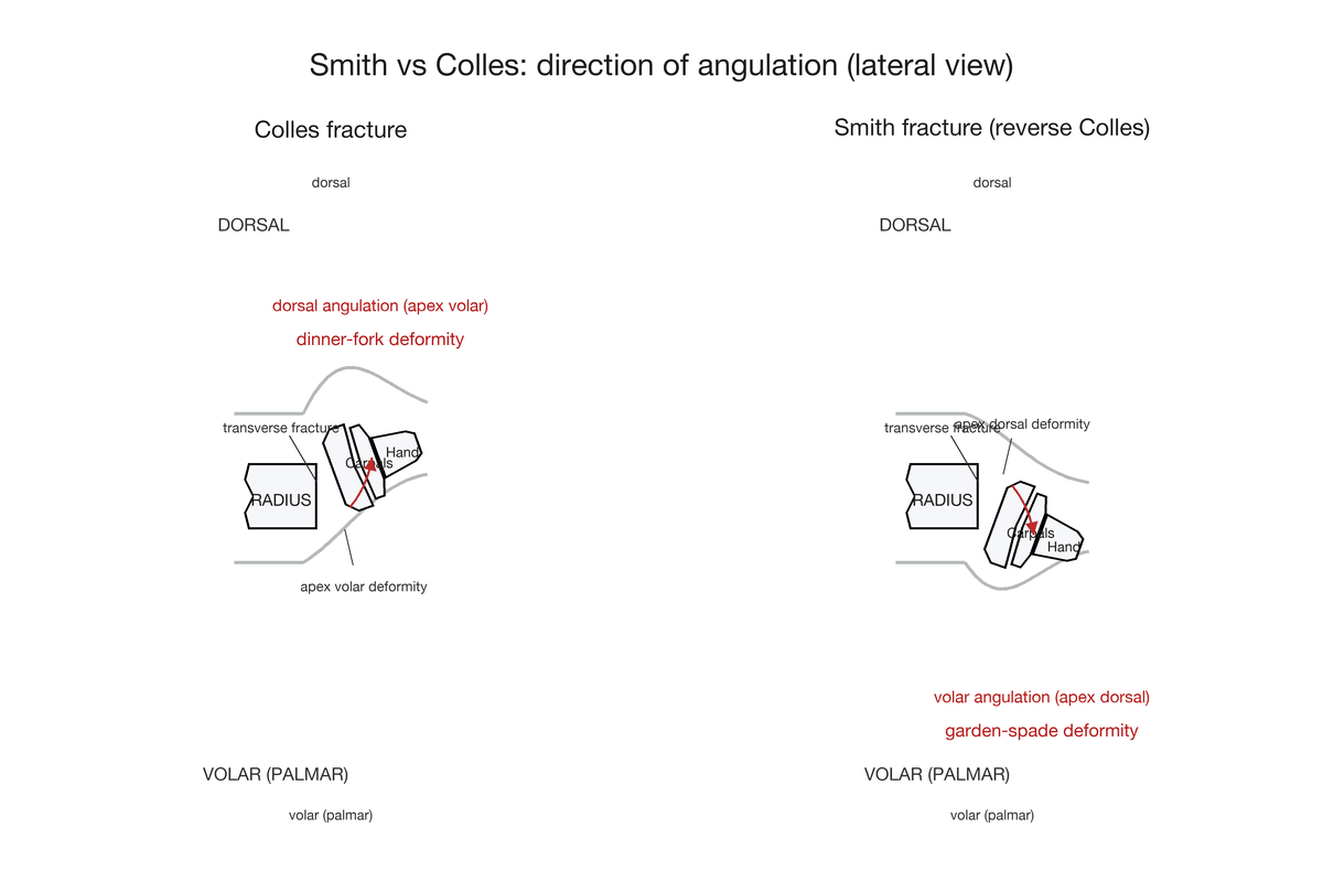 Lateral wrist diagram contrasting the dorsal angulation of a Colles fracture with the volar angulation of a Smith fracture