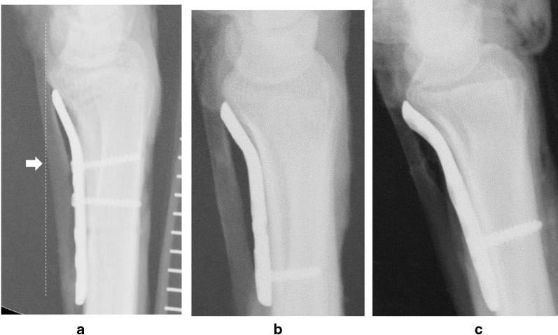 Lateral radiographic sequence of Soong grades 0, 1 and 2 with contrast-opacified flexor pollicis longus illustrating increasing plate contact.