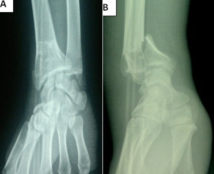 Preoperative AP and lateral radiographs of an intra-articular Smith fracture with volar displacement and a sagittal articular split.