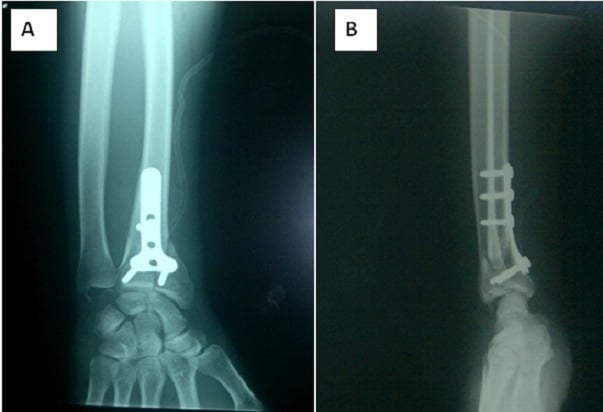 Postoperative AP and lateral wrist radiographs after volar T-plate fixation of an intra-articular Smith fracture.