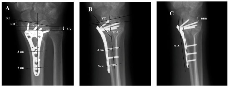 PA and lateral distal-radius radiographs showing radial height, ulnar variance, radial inclination, volar tilt, teardrop angle and the Soong reference line.