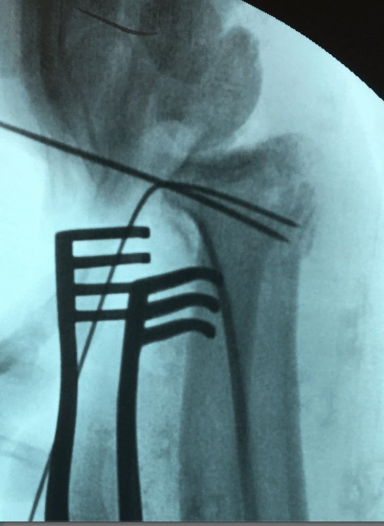 Intraoperative fluoroscopy showing provisional spring-wire fixation of a small volar rim distal-radius fragment beneath a volar plate.