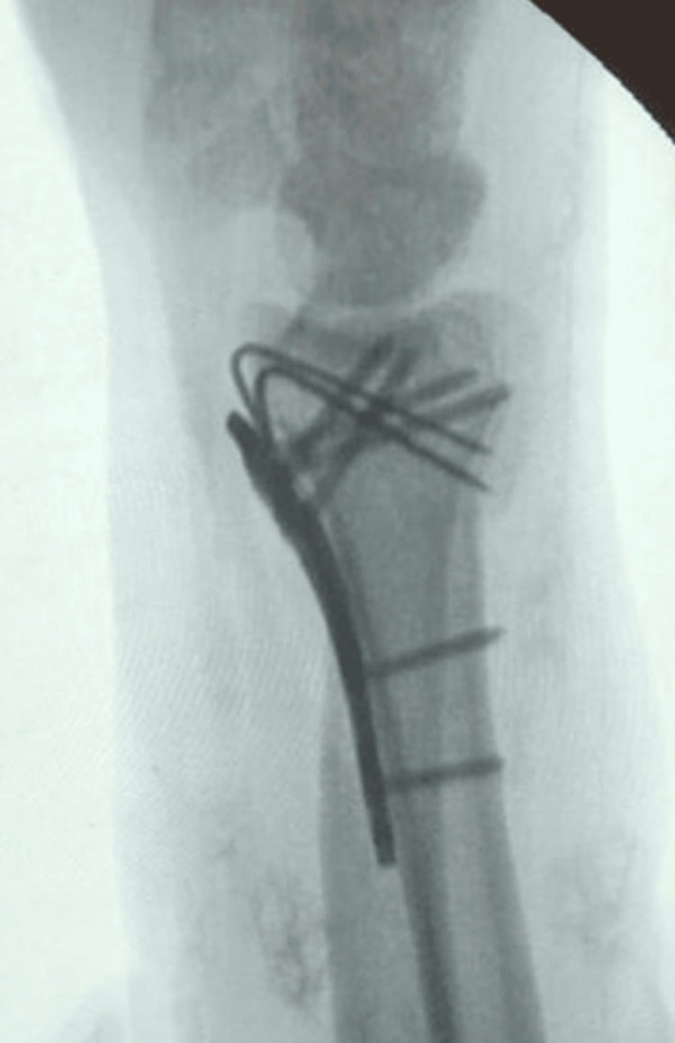 Lateral intraoperative fluoroscopy showing final volar plate and spring-wire fixation of a distal volar rim fragment.