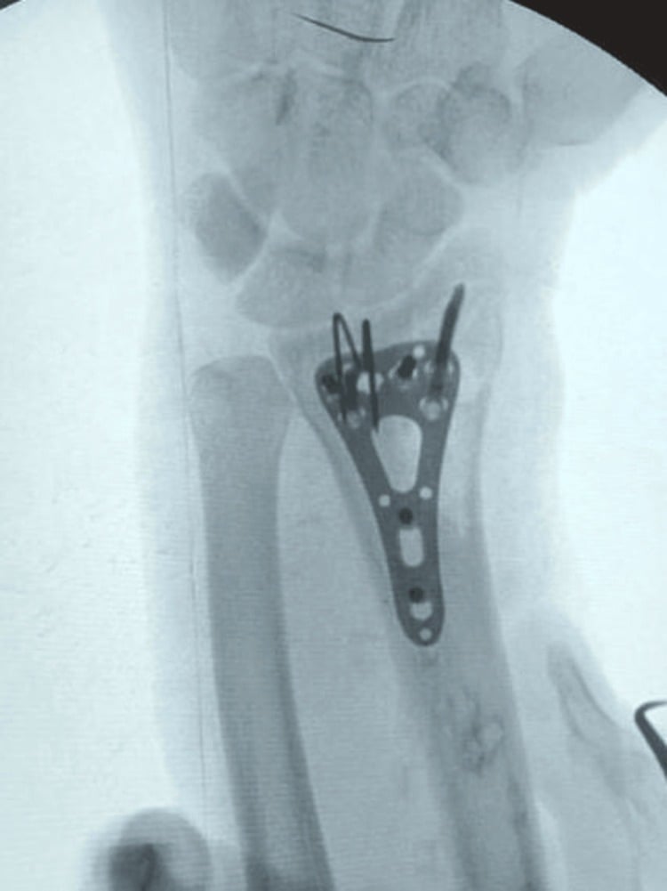 AP intraoperative fluoroscopy showing final volar locking plate and spring-wire fixation of a distal-radius volar rim fracture.