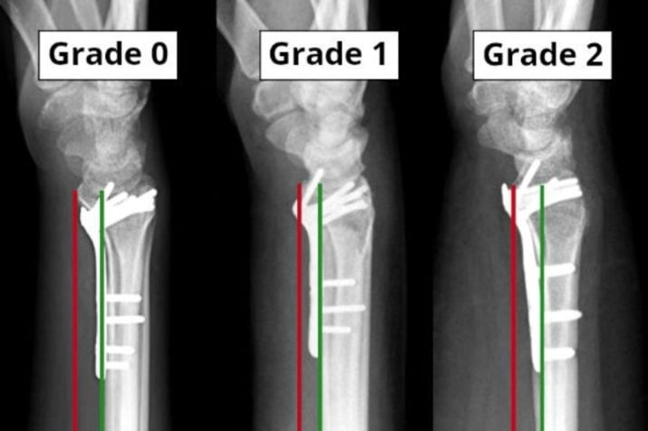 Lateral wrist radiographs illustrating Soong grades 0, 1 and 2 according to volar plate prominence relative to the critical line and volar rim.