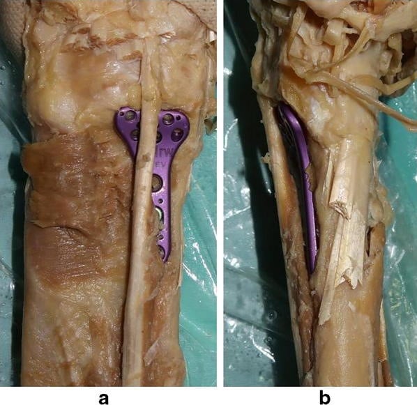 Cadaveric volar wrist dissection showing distal volar plate position and its relationship to the flexor pollicis longus tendon.
