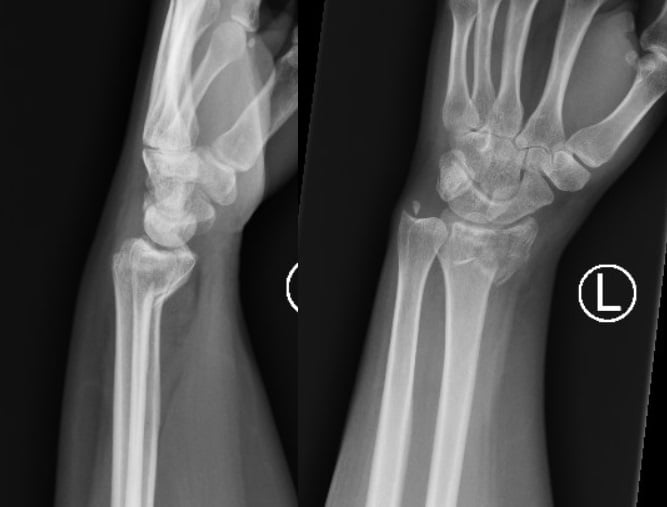 Lateral and AP wrist radiographs of a Smith fracture showing a distal radius fracture with volar displacement of the distal fragment.