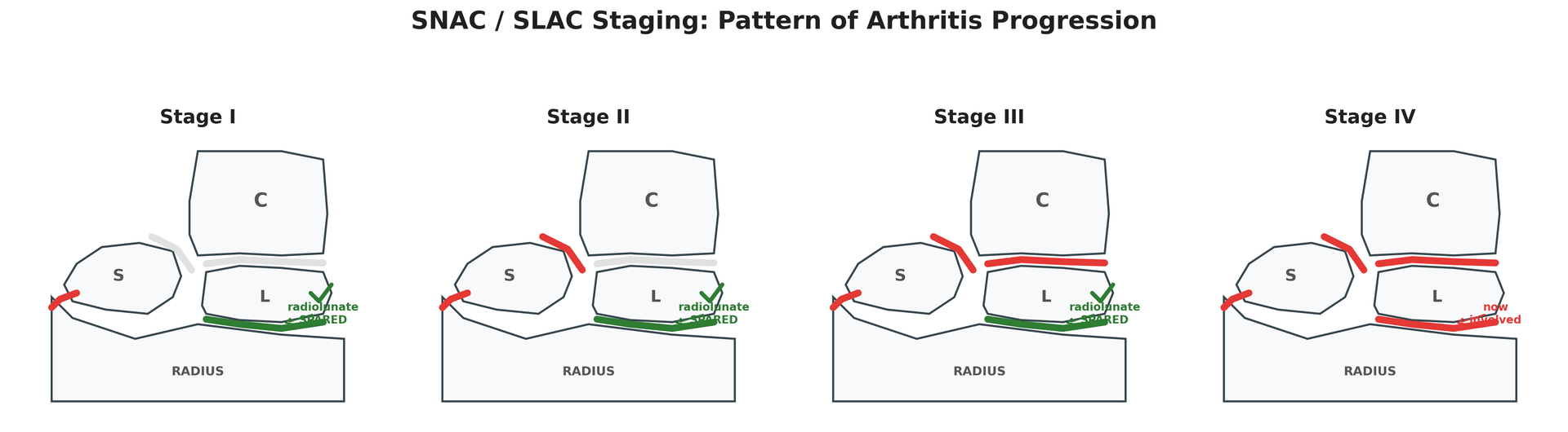 Diagram of SNAC/SLAC staging showing progressive arthritis from radial styloid to pancarpal with the radiolunate joint spared until late