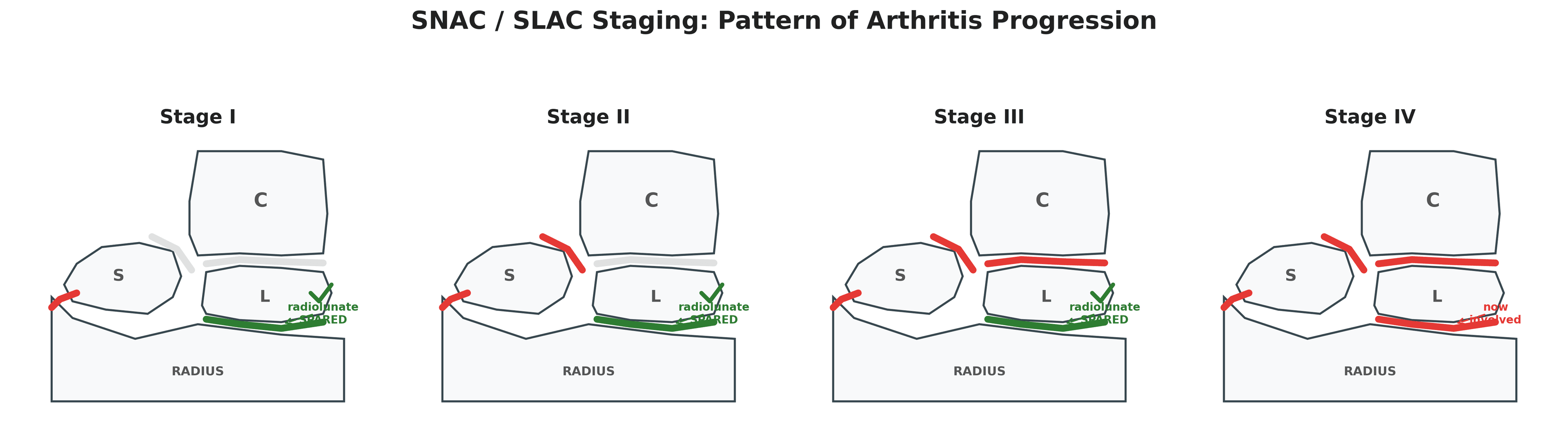 Diagram of SNAC/SLAC staging showing progressive arthritis from radial styloid to pancarpal with the radiolunate joint spared until late