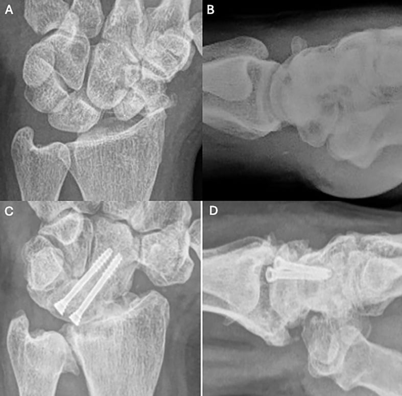 Preoperative and postoperative radiographs of a capitolunate fusion performed for stage II disease