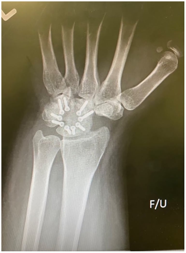 AP radiograph of a four-corner fusion fixed with a circular plate after scaphoid excision