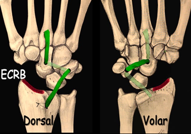 Dorsal and volar schematics of scaphoidectomy with midcarpal tenodesis using an extensor carpi radialis brevis transosseous technique