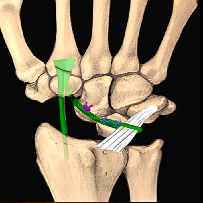 Schematic of scaphoidectomy with midcarpal tenodesis using a flexor carpi radialis tendon slip fixed at the capitate neck