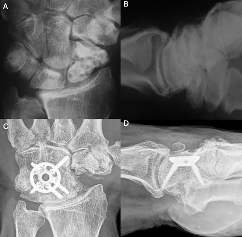 Preoperative AP and lateral radiographs of stage II disease and postoperative films seventeen years after four-corner fusion