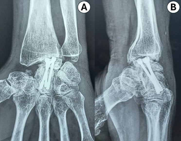 AP and lateral wrist radiographs showing radiolunate osteoarthritis with backed-out screws after a limited carpal fusion
