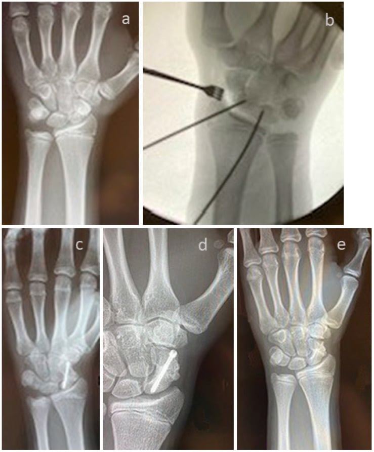 Preoperative radiograph, intraoperative fluoroscopy and postoperative films of a scaphoid nonunion corrected with a structural graft