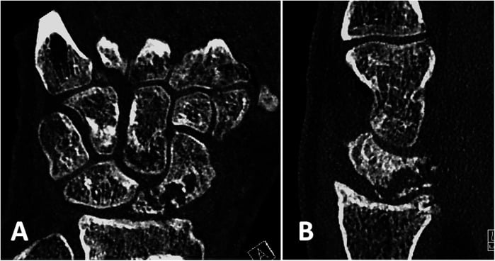 Coronal and sagittal CT of a scaphoid showing failed union with proximal pole fragmentation and progressive arthrosis