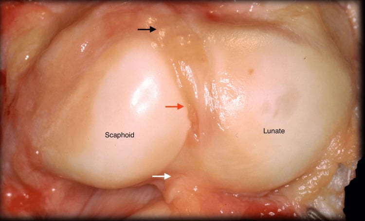 Arthroscopic view from the radiocarpal joint showing the dorsal, membranous and volar parts of the scapholunate ligament