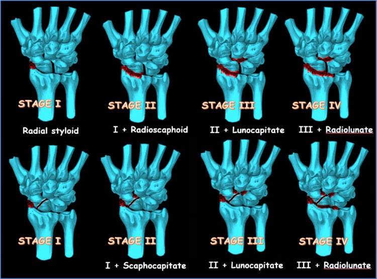 Diagram of SLAC and SNAC staging showing progression from radial styloid through radioscaphoid, capitolunate and radiolunate involvement