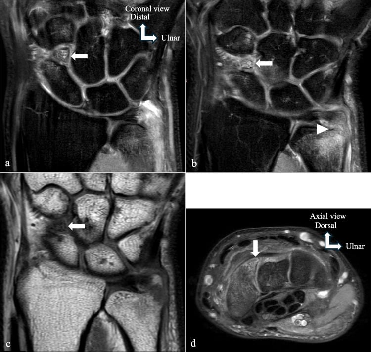 Coronal and axial MRI of the wrist showing carpal marrow oedema and detailed carpal anatomy