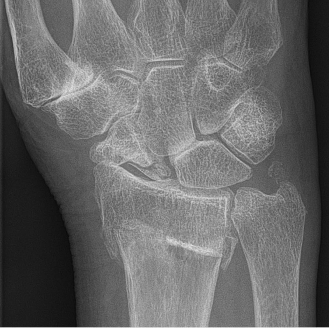 PA wrist radiograph of scaphoid nonunion advanced collapse showing scaphoid nonunion with radioscaphoid arthritis and carpal collapse.