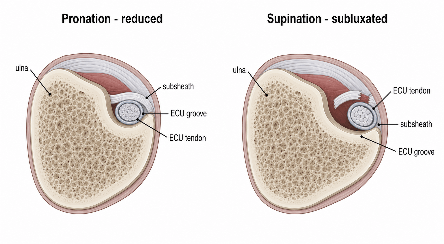 Axial cross-section of the distal ulna showing the ECU tendon reduced in its groove in pronation and subluxated out of the groove in supination