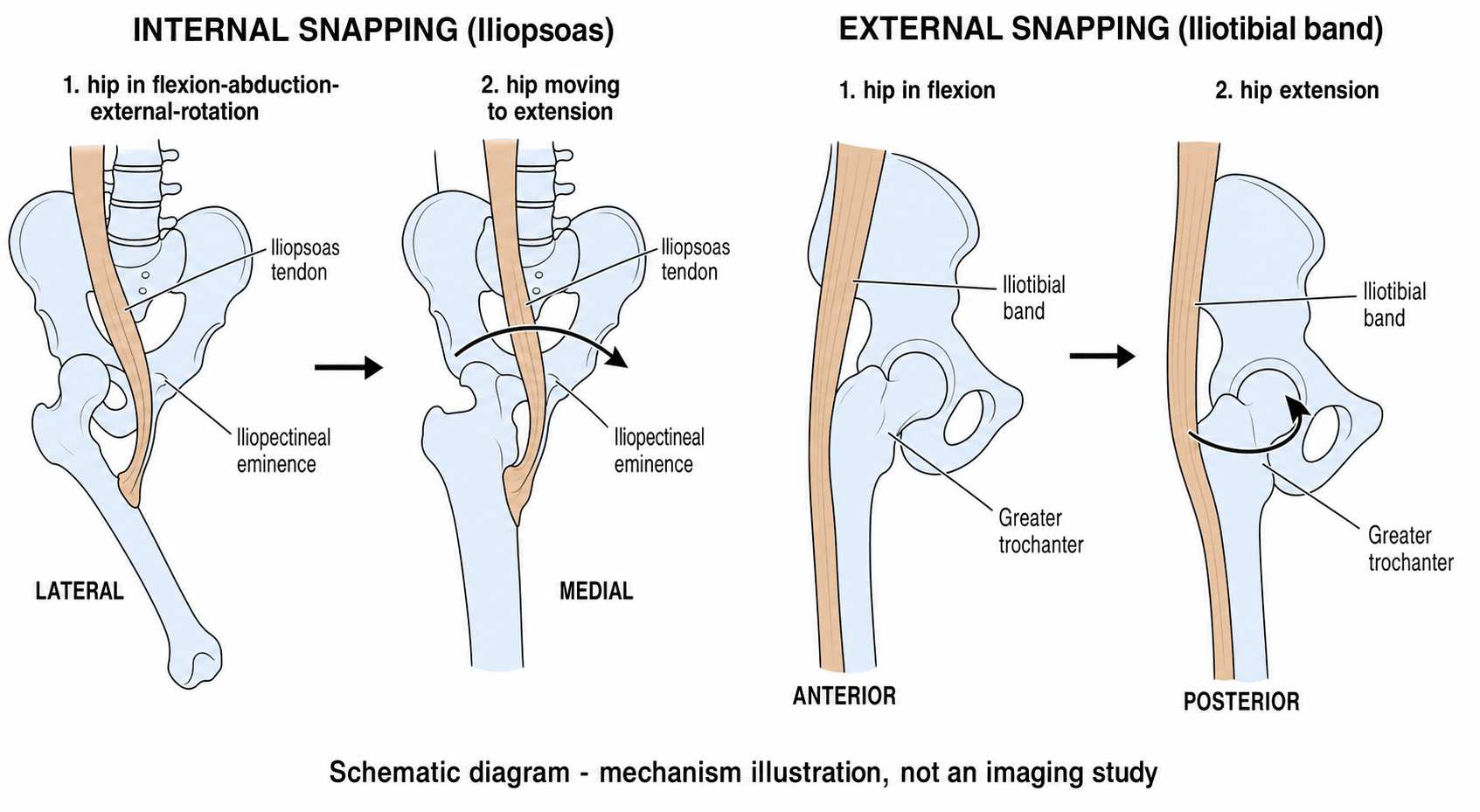 Schematic diagram of internal (iliopsoas) and external (iliotibial band) snapping hip mechanisms