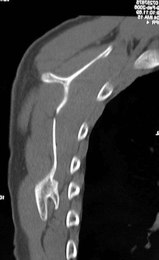 Structural CT anatomy showing a pedunculated osteochondroma arising from the costal surface of the scapula