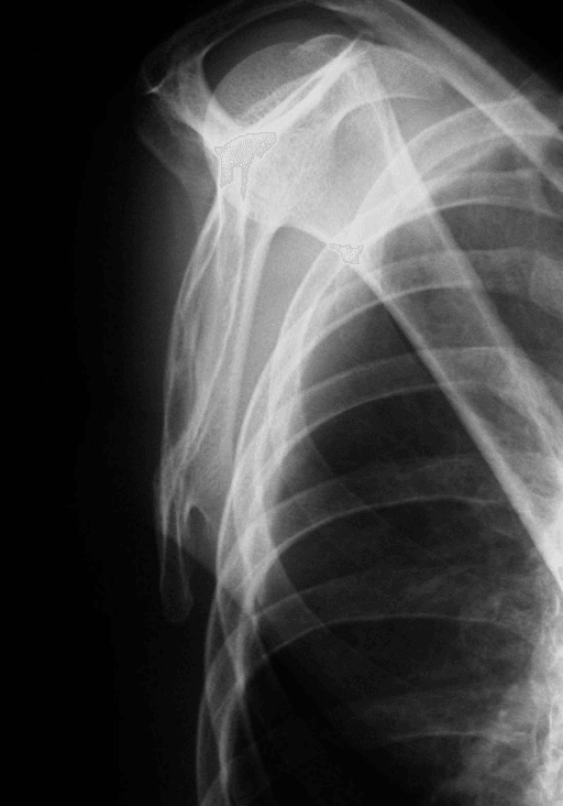 Transscapular radiograph showing a pedunculated osteochondroma projecting from the inferior scapular body