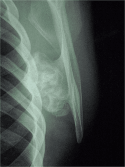Scapular radiograph showing a large lobulated osteochondroma over the medial scapular body