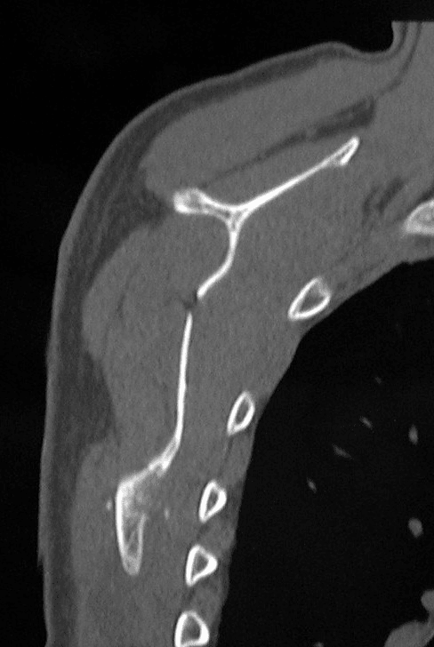 Postoperative CT showing marked reduction of a costal-surface scapular osteochondroma