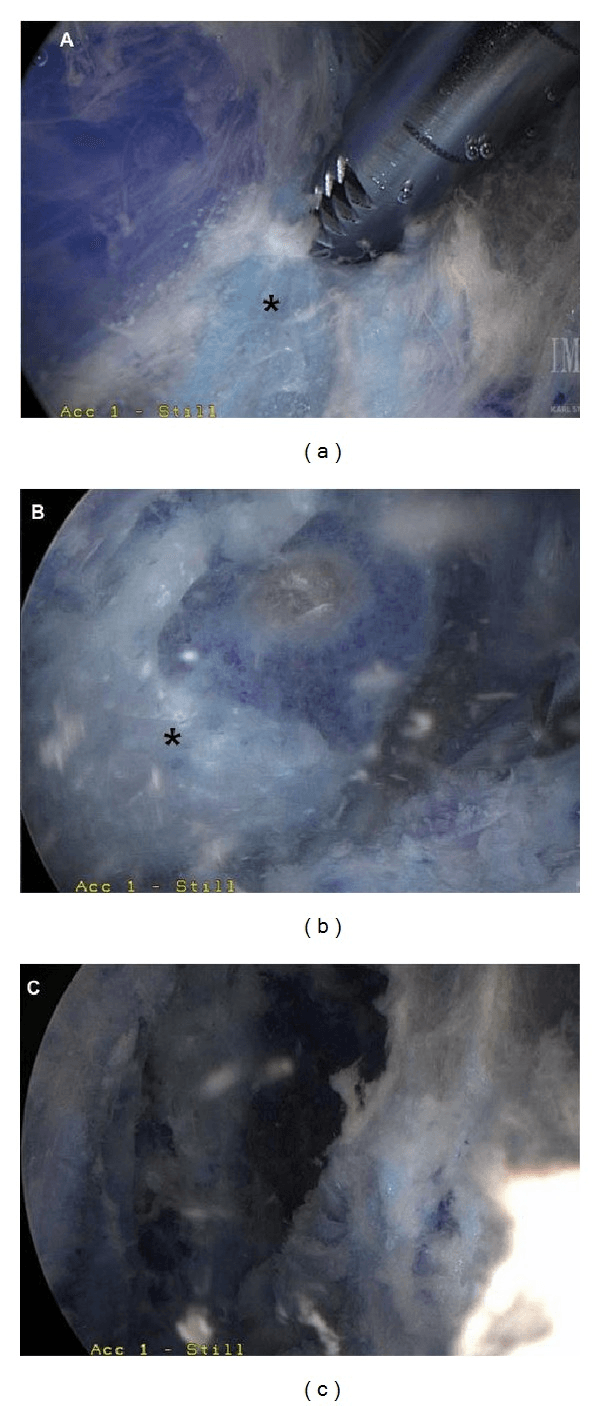 Operative-pathway arthroscopic sequence showing shaver debridement of inflamed scapulothoracic bursa