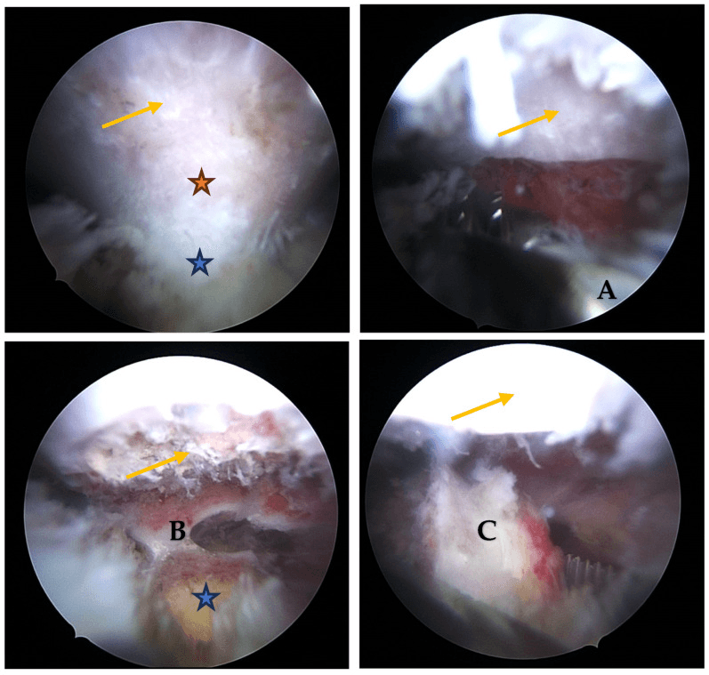 Arthroscopic sequence showing resection of a cartilaginous exostosis from the ventral scapular blade