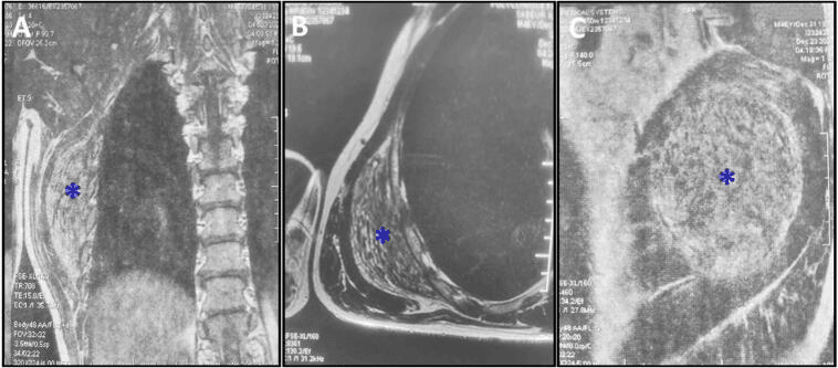 Coronal and axial MRI showing elastofibroma dorsi deep to the inferior scapular angle