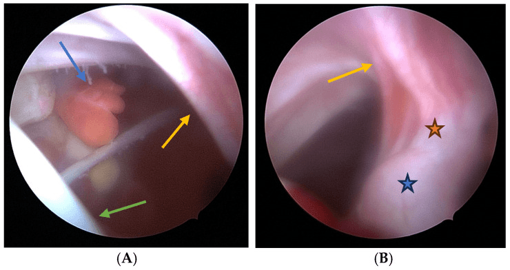 Arthroscopic anatomy showing inflamed scapulothoracic bursa around a ventral scapular exostosis