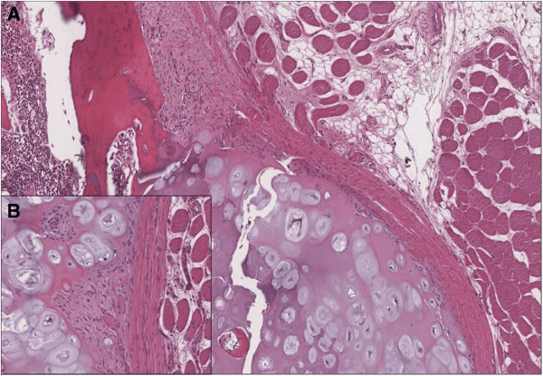 Histology showing the cartilage cap, trabecular bone and fibrous perichondrium of a benign osteochondroma