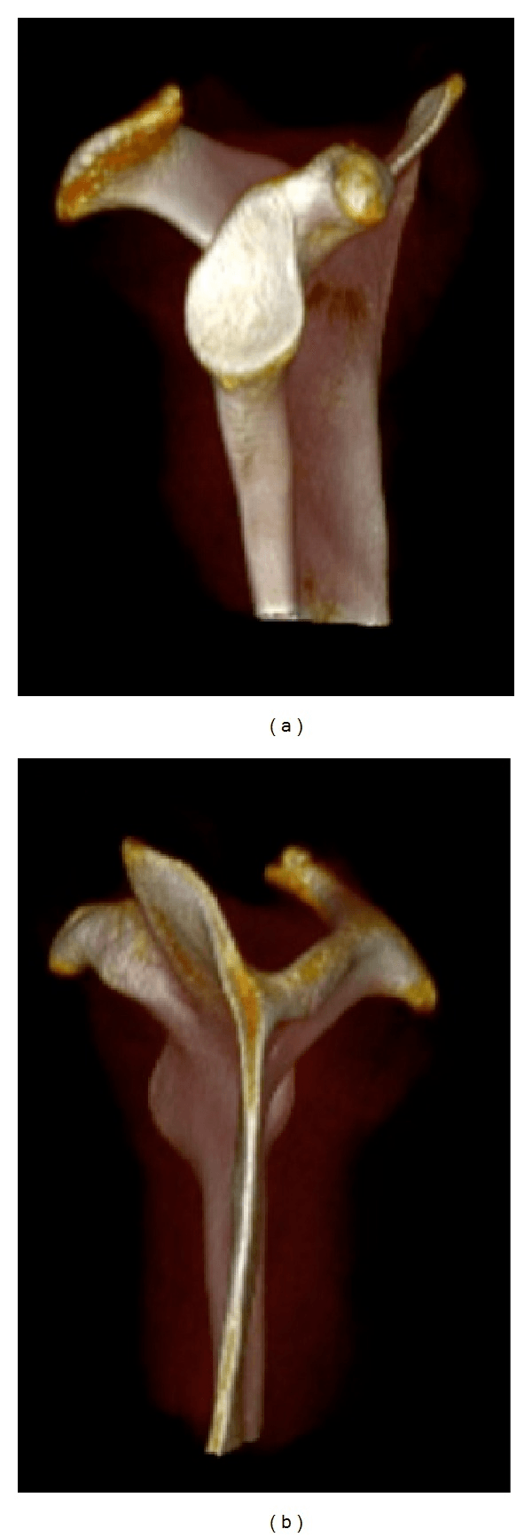Three-dimensional CT anatomy showing lateral and medial scapular osseous morphology
