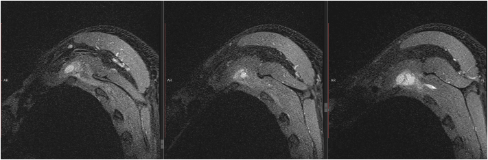 Axial fluid-sensitive MRI showing scapulothoracic bursitis