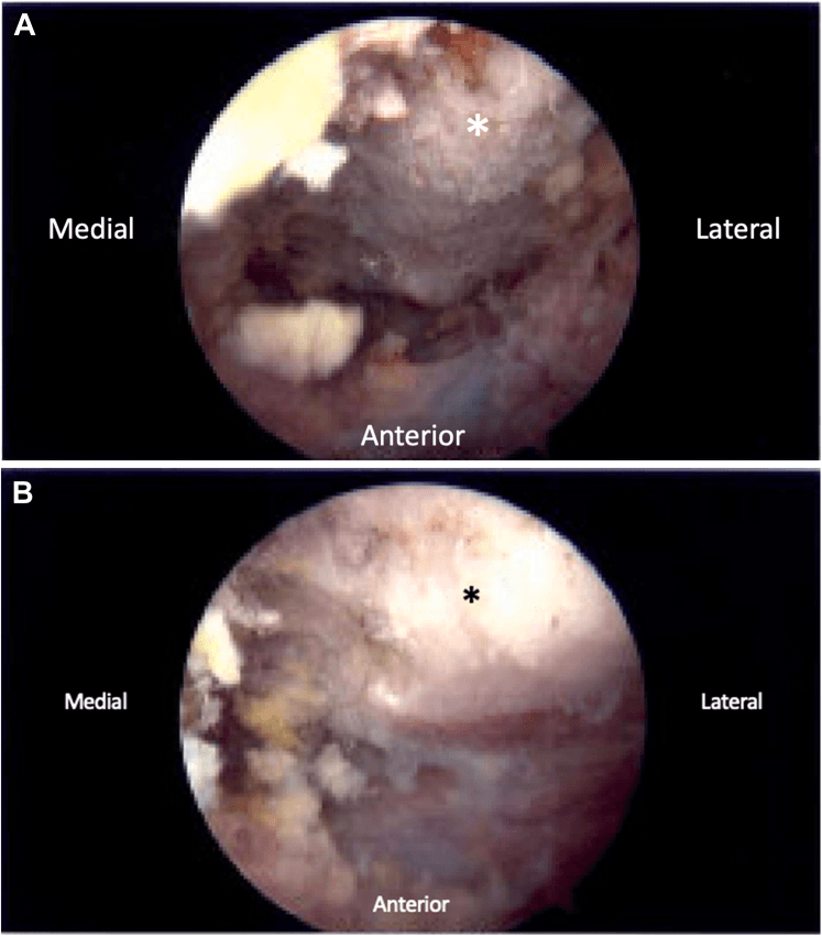 Operative-pathway arthroscopy of the superomedial scapular angle before and after limited resection