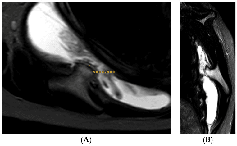 Axial and sagittal T1 MRI showing a ventral scapular cartilaginous exostosis and adjacent bursal inflammation