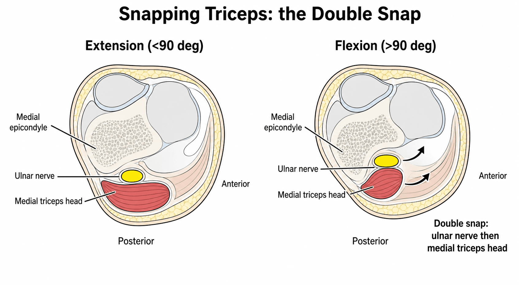 Axial elbow schematic comparing the ulnar nerve and medial triceps head in extension and flexion