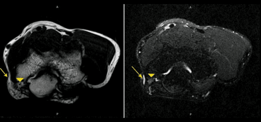 Axial T2-weighted MRI and T2 FS of the elbow showing fluid and enlarged ulnar nerve