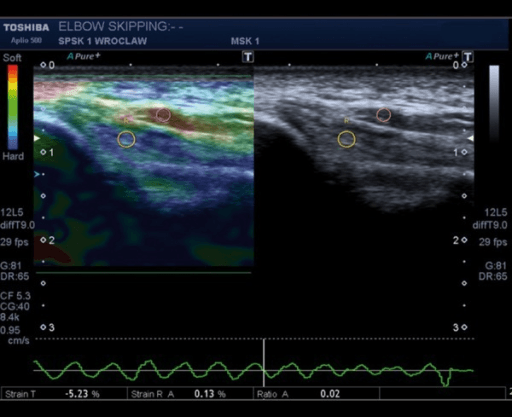 Sonoelastography and B-mode ultrasound showing a bifurcated medial triceps head with an accessory muscle band