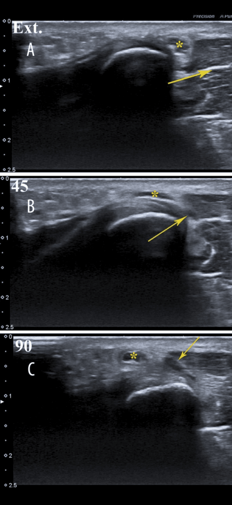 Dynamic longitudinal ultrasound of the medial elbow in three positions showing ulnar nerve and accessory muscle band dislocation